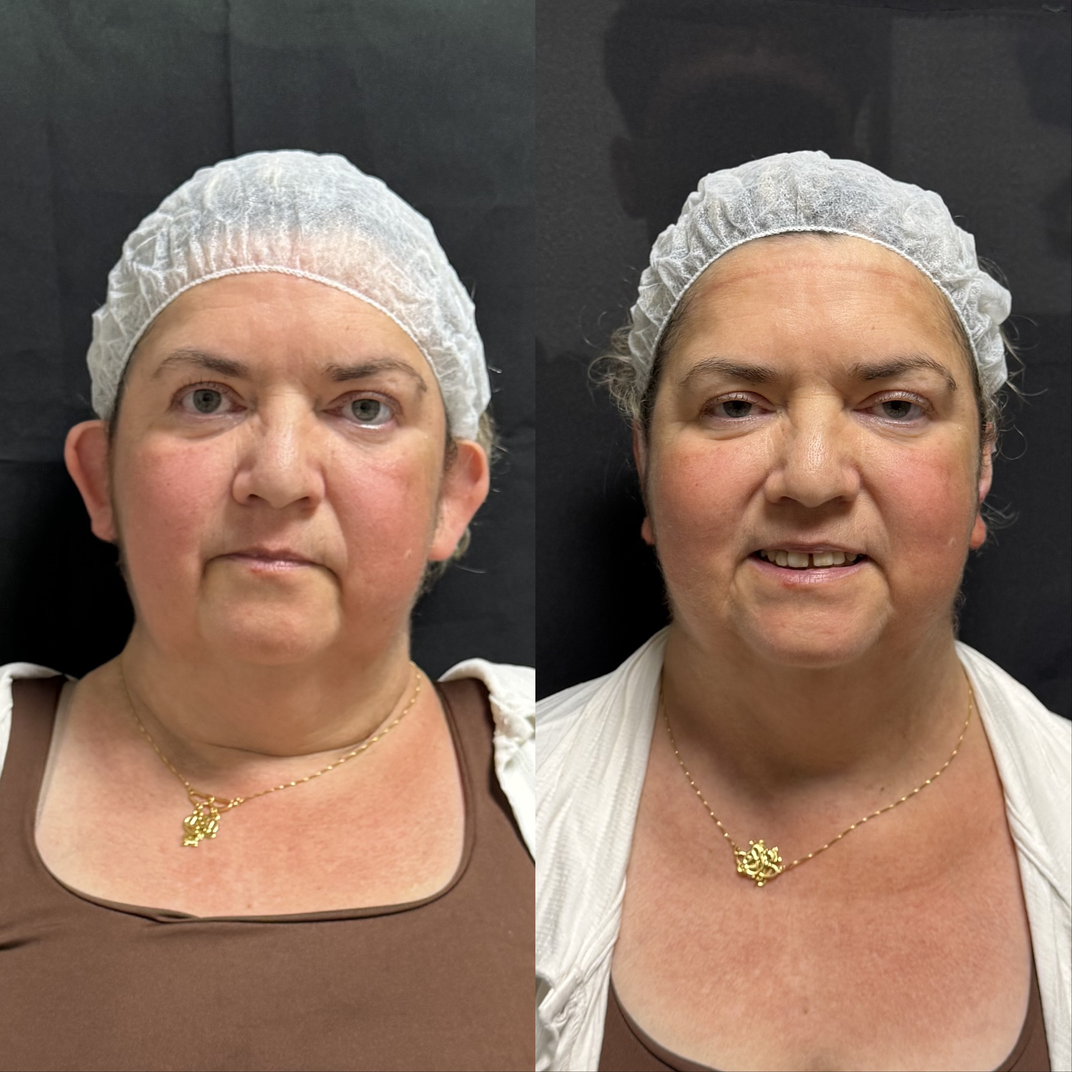Resultado de Otomodelação — antes e depois