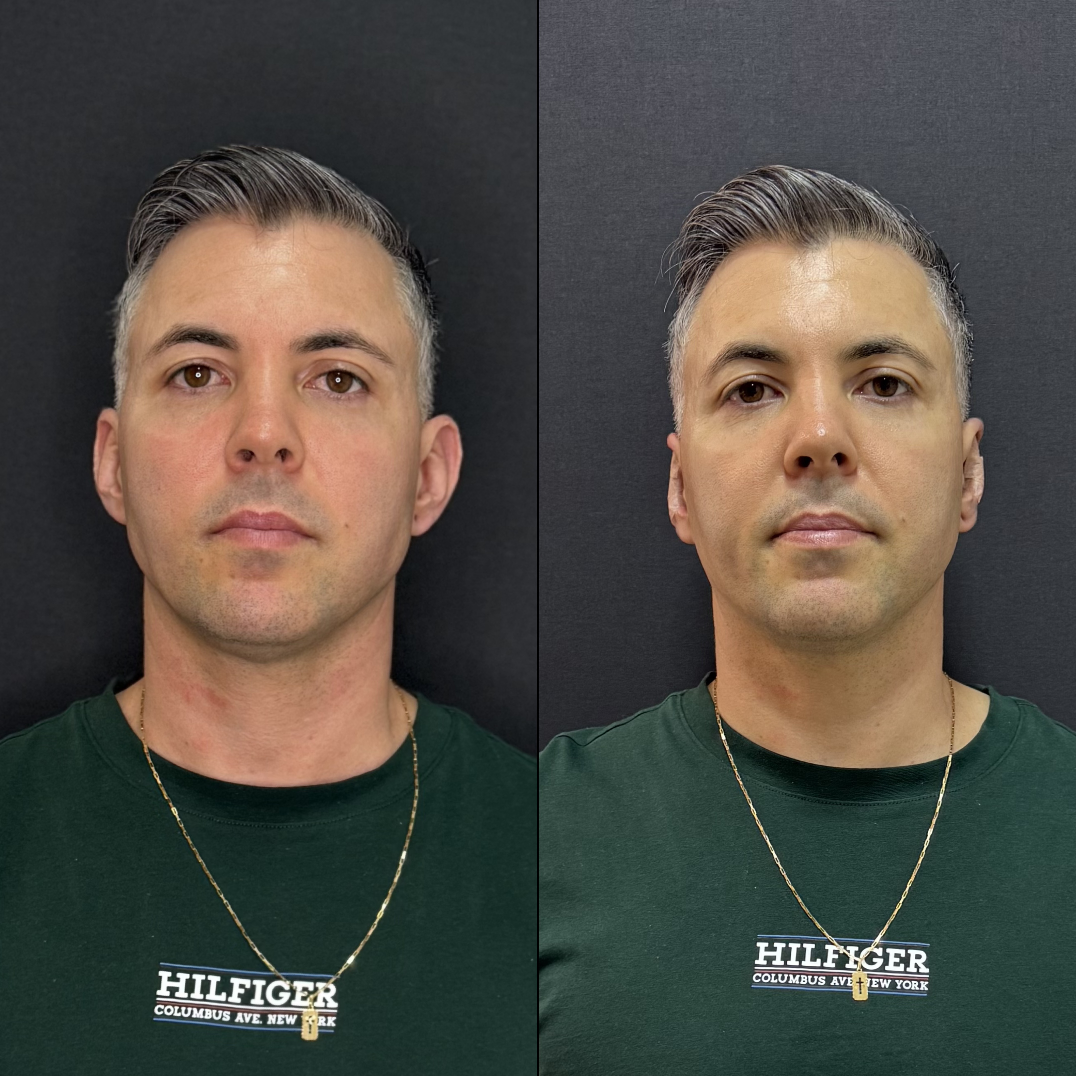 Resultado de Otomodelação — antes e depois